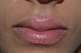 clinical challenge swollen lips mpr