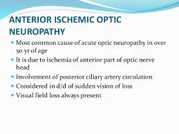 Potential pathophysiologic mechanisms of this rare occurrence are discussed. Ischemic Optic Neuropathy