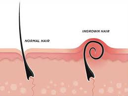 It tends to appear after hair removal by shaving or waxing and can affect both male and female persons. What Are The Most Efficient Ways To Get Rid Of Ingrown Hairs Quora