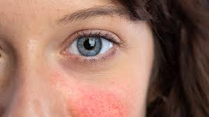 what is rosacea and what can you do
