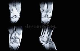 They are attached to the femur (thighbone), tibia (shinbone), and fibula (calf bone) by fibrous tissues called ligaments. Magnetic Resonance Imaging Mri Of Right Knee Closed Injury Of The Knee Joint With Manifestations Of Arthrosis Stock Image Image Of Muscle Broken 172761363