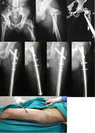 subtrochanteric femur fracture treated