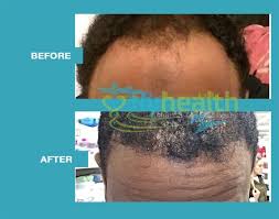 Check out these incredible hair transplant before and after results of hair transplant surgeries per. Black Hair Transplant Before And After Photo Gallery