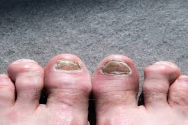 does home laser work on toenail fungus
