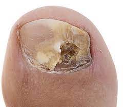 horizontal ridges on my toenail
