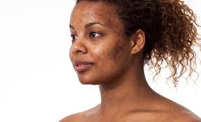 deep acne scars prevention tips and