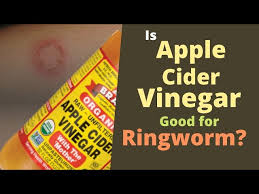 apple cider vinegar for ringworm does