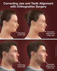 How to correct underbite without surgery. Orthodontics Surgery Amy B Farnsworth D M D Louisville Kentucky