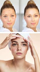 remes to remove acne marks from face