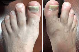 onychomycosis bako diagnostics