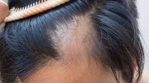 s with severe alopecia areata
