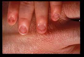 nail patella syndrome hereditary osteo