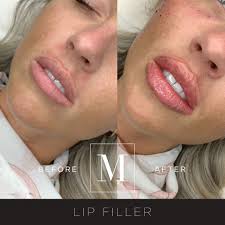 lip and augmentation with dermal