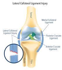 lateral collateral ligament surgery