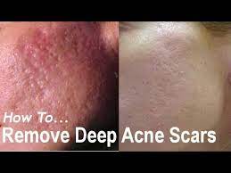 deep acne scars acne scarring removal