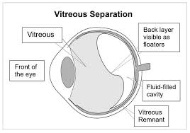 floater flashes and vitreous