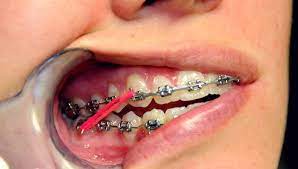 Are rubber bands the final stage of braces? What Do The Elastic Rubber Bands On Braces Do Ask An Orthodontist Com
