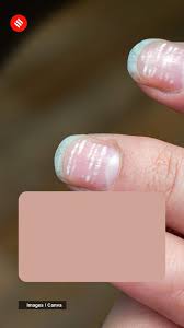 deficiency causes white spots on nails