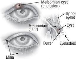 blepharitis guide causes symptoms and
