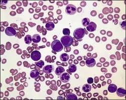 How To Treat Chronic Myeloid Leukemia Cml In Ayurveda