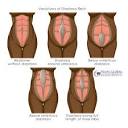 Diastasis Recti: How to heal your abdominal separation