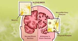 Demens er en paraplybetegnelse for en unaturligt hurtig nedgang i de kognitive funktioner. 10 Ting Du Kan Gjore For A Forebygge Alzheimer