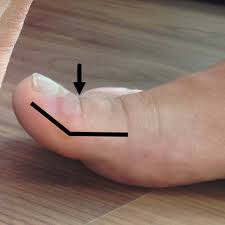 toenail blisters 7 causes 7 fi