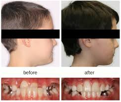 Depending on the severity of the underbite, extracting one or more teeth from the lower jaw may also help improve the appearance of an underbite. Correcting Underbites In Kids Hometown Orthodontics