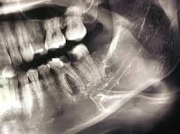 understanding sinus toothaches relief