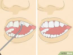 to straighten your teeth without braces