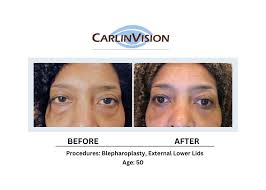 eyelid surgery carlinvision