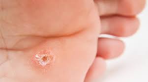 warts skin conditions cal