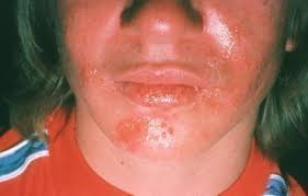 herpes simplex pariser dermatology