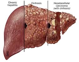 Hasil gambar untuk hepatitis c