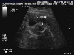 ultrasound of cleft lip and palate