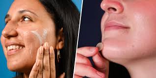 21 best acne spot treatments plus