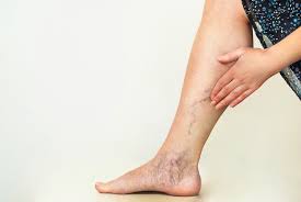 7 home remes for varicose veins
