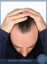 Hair loss is devastating for any person, be it male or female. The Secret Weapons To Combating Hair Loss The Cooden Medical Group The Cooden Medical Group