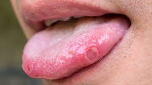 herpes on the tongue symptoms and