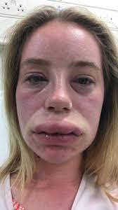 woman left suffering from swollen lips