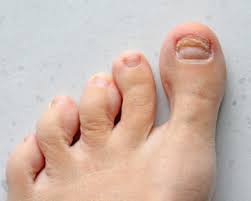 toenail injuries podiatrists foot