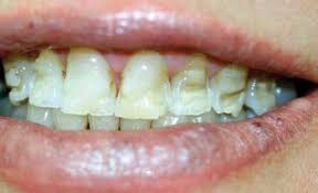 It can easily be used in many diy teeth whitening recipes. Bulimia Decreasing The Damage To Enamel Registered Dental Hygienist Rdh Magazine