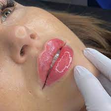 aftercare for lip fillers beauty bar