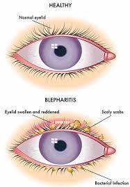 itchy eyelids blepharitis treatment