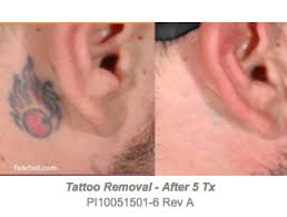 picoclear tattoo removal dr shadan