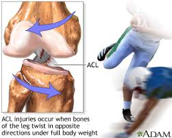 Facebook is showing information to help you better understand the purpose of a page. Anterior Cruciate Ligament Acl Injury Multimedia Encyclopedia Health Information St Luke S Hospital