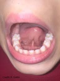 tongue tie why i can t wait for the