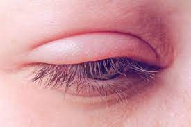 swollen eyelid causes treatments