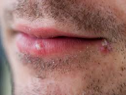 cold sore remes your faqs answered