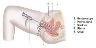 hysteroscopy under general anaesthesia